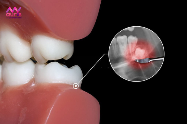 Răng khôn mọc lệch ra má hàm dưới là gì?