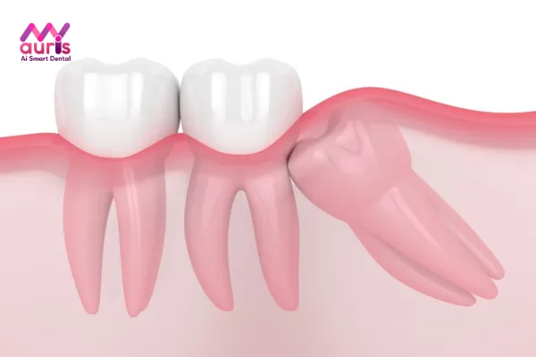 Răng khôn mọc ngầm có nguy hiểm không?