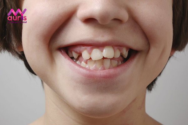 Tìm hiệu tình trạng răng mọc lệch ở trẻ em 