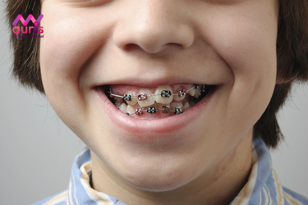 Điều trị răng mọc lệch ở trẻ em bằng cách nào?