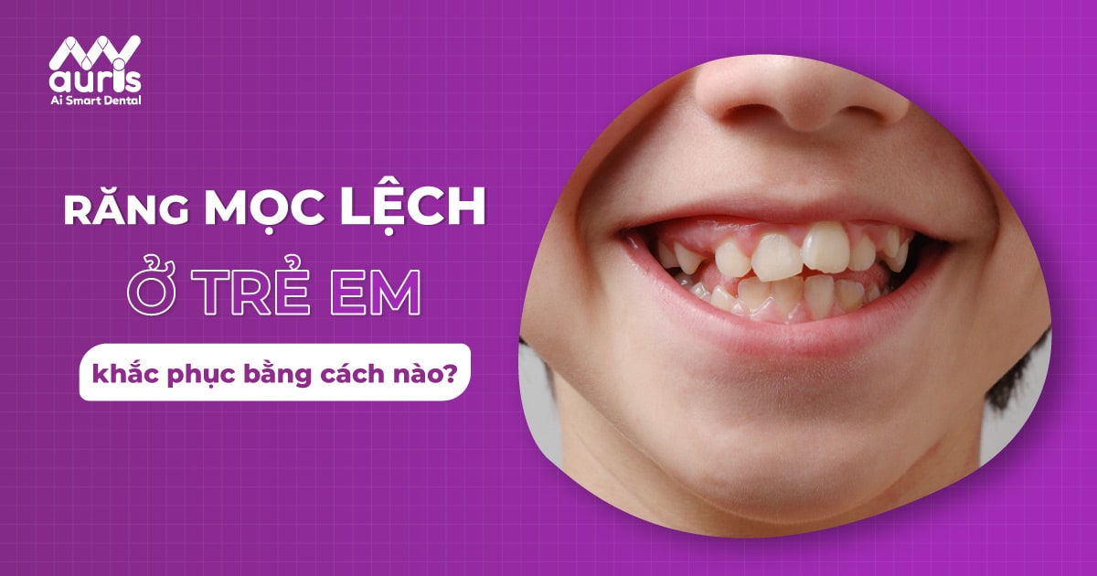 Răng mọc lệch ở trẻ em là gì và có thể khắc phục bằng cách nào?