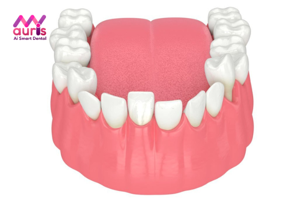 Ảnh hưởng của răng cửa hàm dưới mọc lệch vào trong