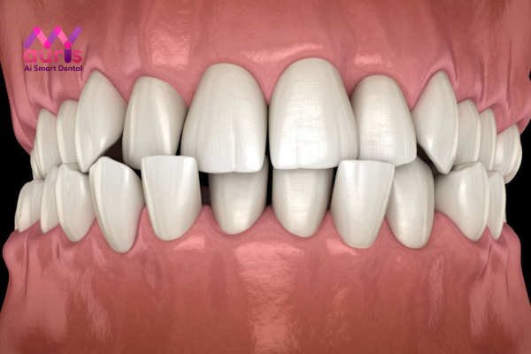 Răng cửa hàm dưới mọc lệch vào trong là gì?