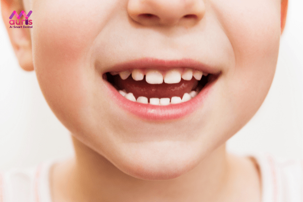 Tầm quan trọng của răng sữa - Trẻ bị gãy răng sữa có mọc lại không? 