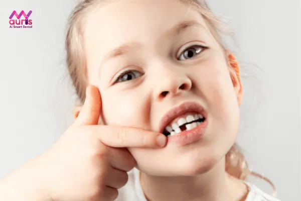 những hậu quả trẻ gãy răng sữa - Trẻ bị gãy răng sữa có mọc lại được không? 