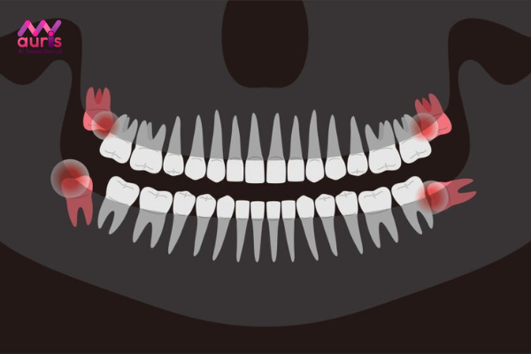 Nhổ răng khôn hàm trên mọc lệch là gì?