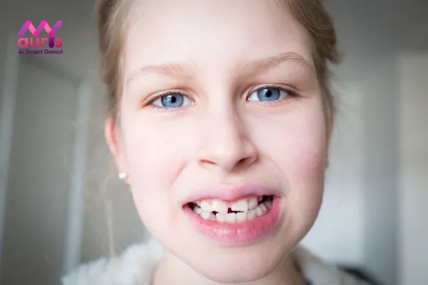 Tình trạng răng cửa mọc lệch hàm trên là do đâu?