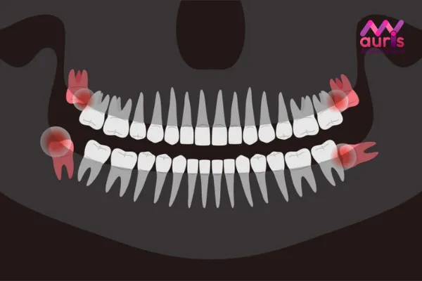 Vì sao lại có tình trạng răng khôn hàm trên mọc lệch ra má?