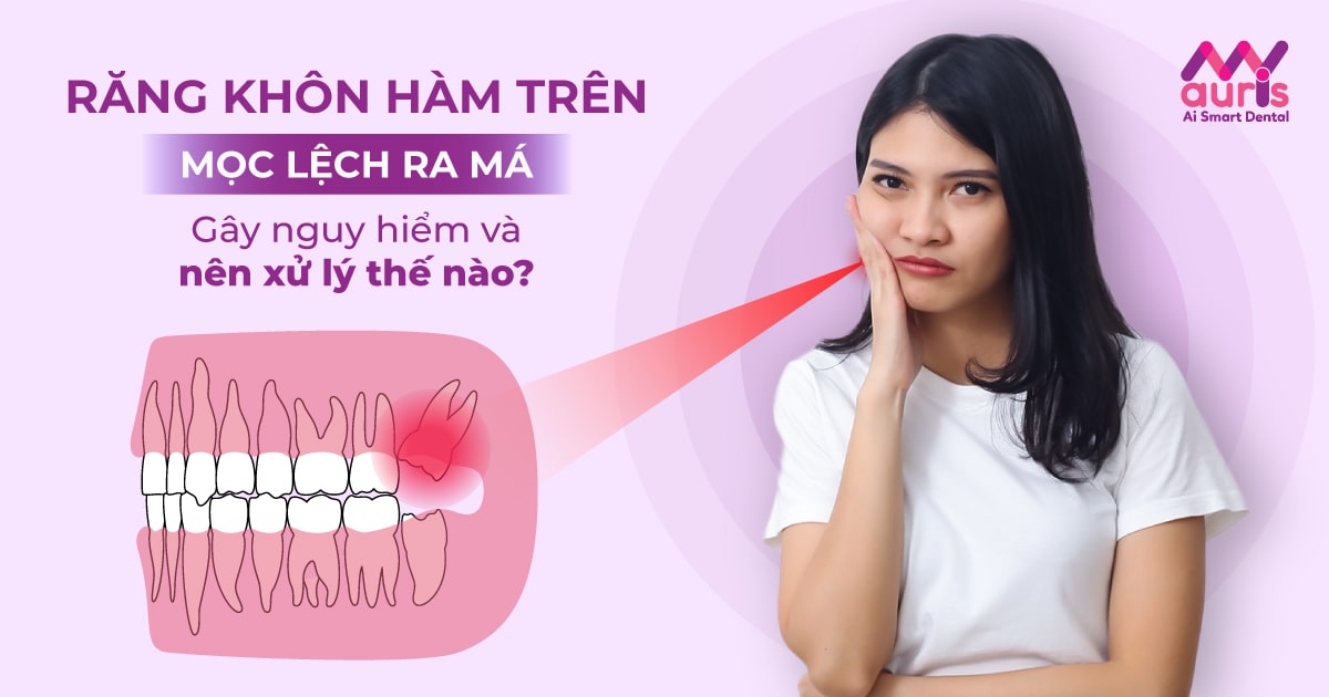 Răng khôn hàm trên mọc lệch ra má nên xử lý thế nào?