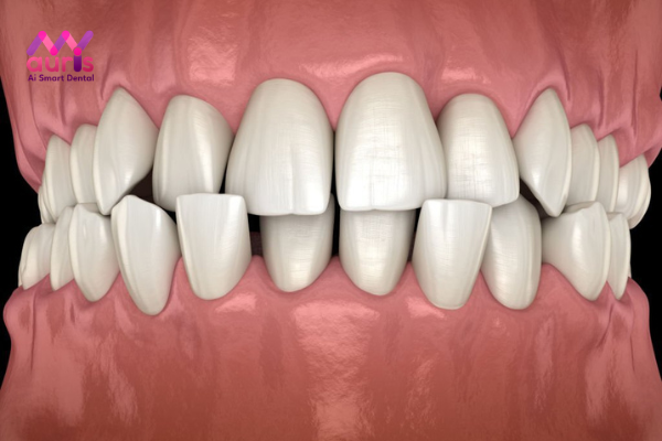 Răng khôn mọc lệch 45 làm răng bị xô lệch
