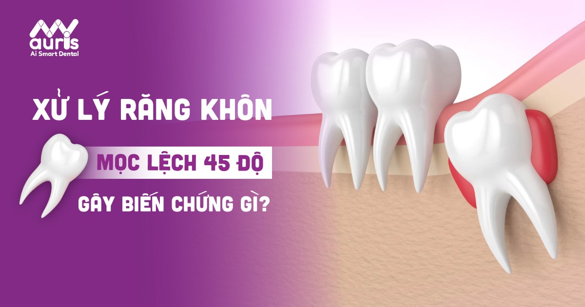 Xử lý răng khôn mọc lệch 45 độ sao cho an toàn hiệu quả