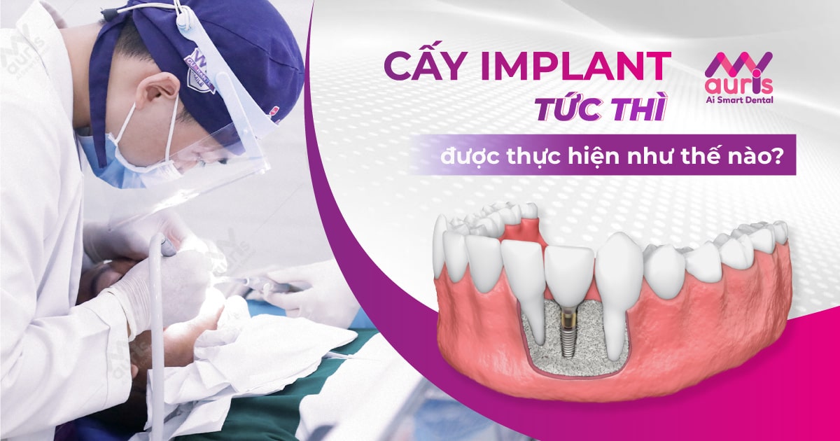 cấy implant tức thì