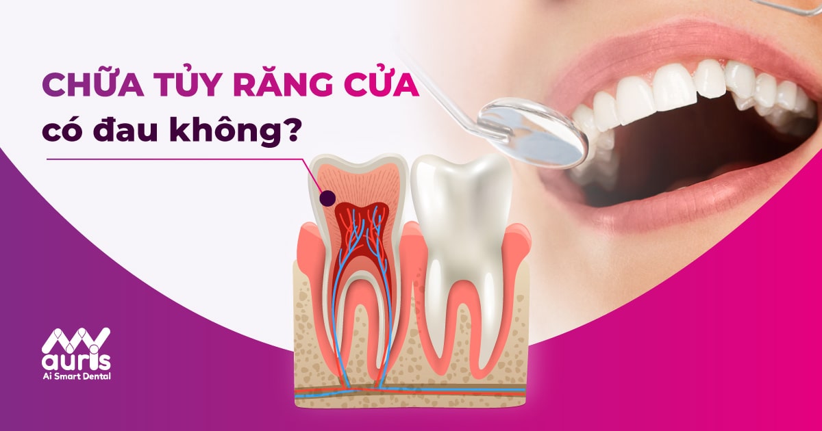 chữa tủy răng cửa