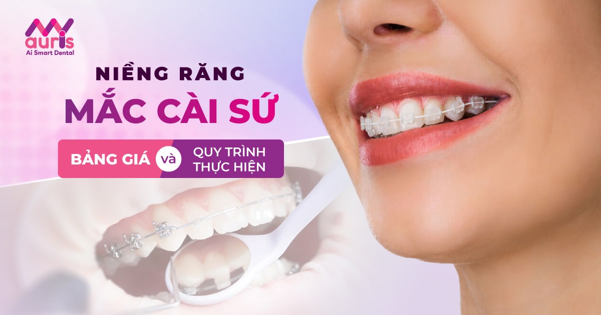 Tìm hiểu bảng giá niềng răng mắc cài sứ và quy trình niềng răng