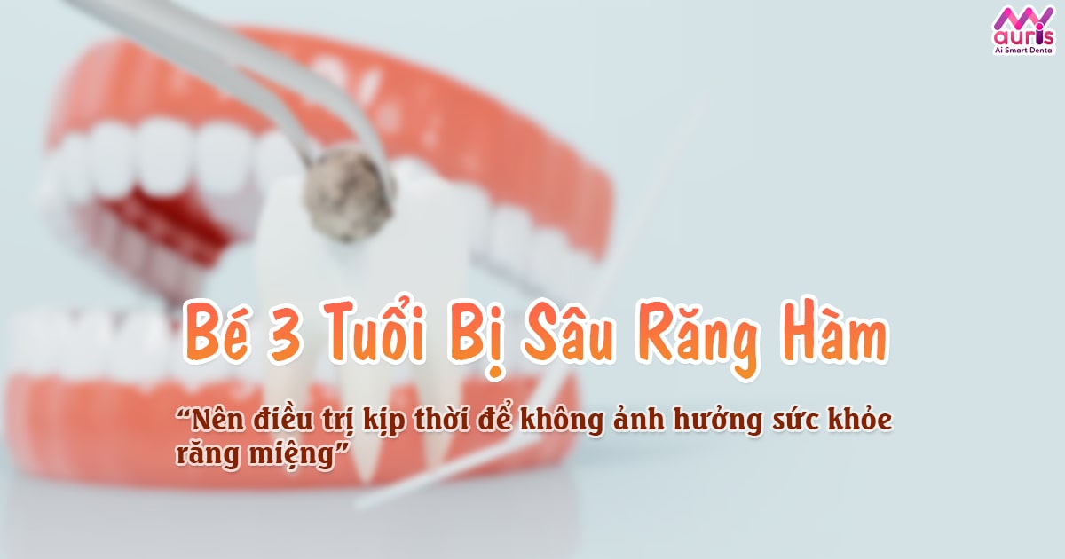 bé 3 tuổi bị sâu răng hàm