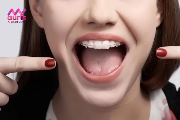 Các loại niềng răng mắc cài sứ - Loại truyền thống