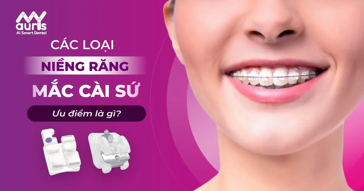 Các loại niềng răng mắc cài sứ có ưu điểm gì?