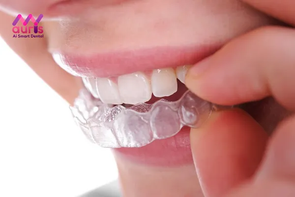 Các loại niềng răng trong suốt nào đang được sử dụng nhiều?