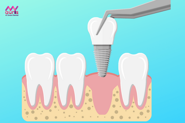 Có nên trồng răng implant? cách trồng răng implant