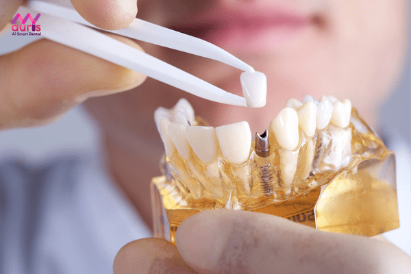 Cách trồng răng implant tiêu chuẩn