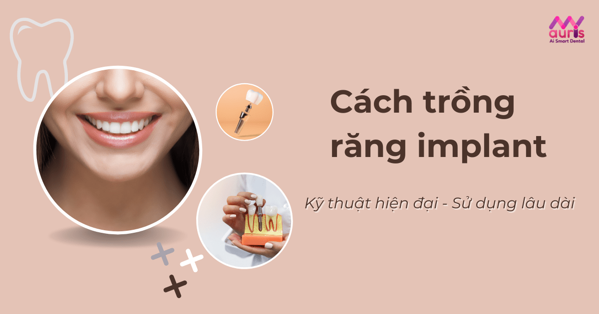 Cách trồng răng implant tiêu chuẩn như thế nào?