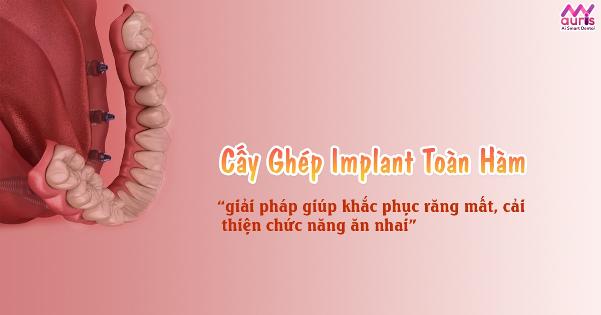 cấy ghép implant toàn hàm, trồng răng implant toàn hàm