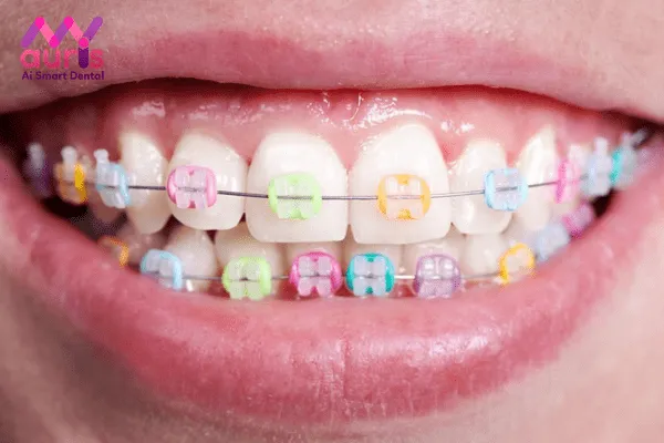 Niềng răng mắc cài sứ được thực hiện như thế nào?