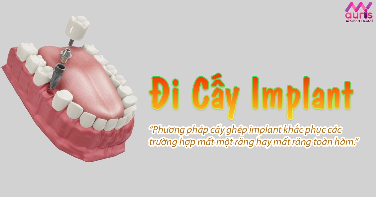 đi cấy implant