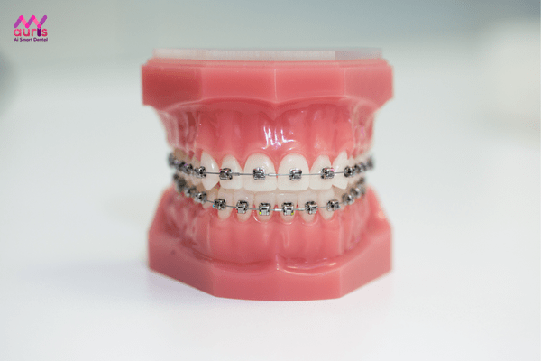 Răng hô nhẹ có nên niềng răng không? giá tiền niềng răng hô nhẹ