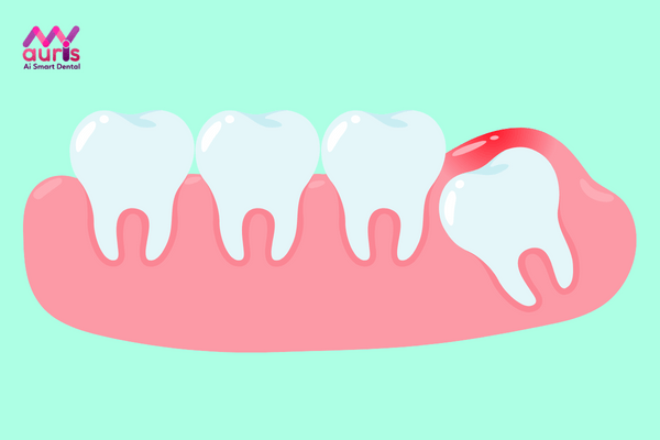 Biến chứng Thời điểm mọc răng khôn - mọc răng khôn hàm dưới bên trái có nên nhổ?