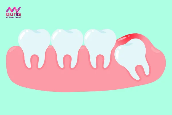 Biến chứng Thời điểm mọc răng khôn - mọc răng khôn hàm dưới bên trái có nên nhổ?