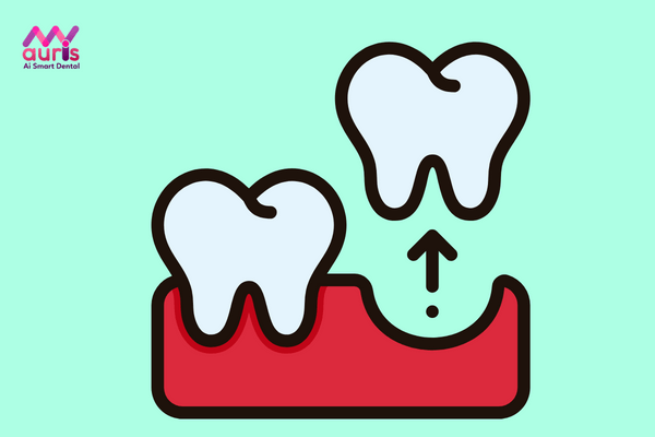 Mọc răng khôn hàm dưới bên trái có nên nhổ không?