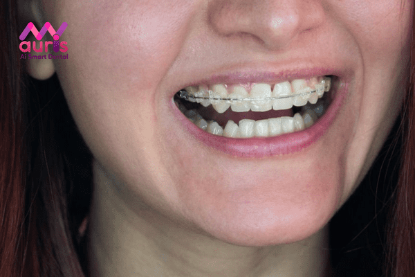 Yếu tố ảnh hưởng khi niềng răng mắc cài sứ