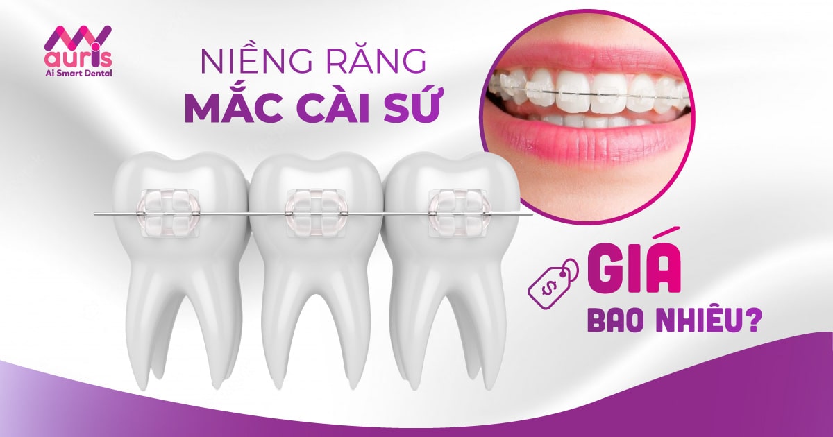 Niềng răng mắc cài sứ bao nhiêu và yếu tố ảnh hưởng