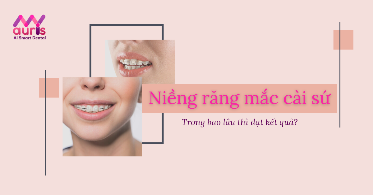 Niềng răng mắc cài sứ bao lâu và phụ thuộc yếu tố nào?