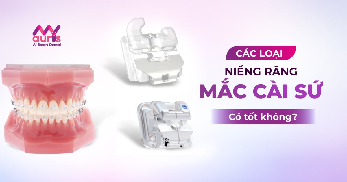 Niềng răng mắc cài sứ có tốt không và có mấy loại?