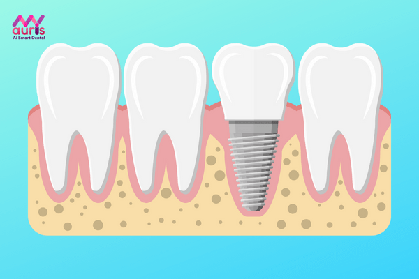 Kỹ thuật trồng răng implant là gì?