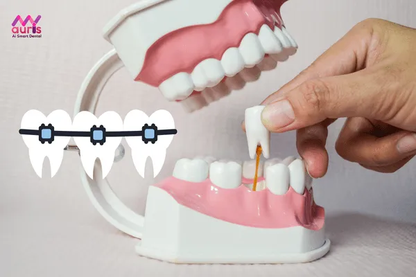 Vì sao cần nhổ răng khi niềng? niềng răng hô không cần nhổ răng 