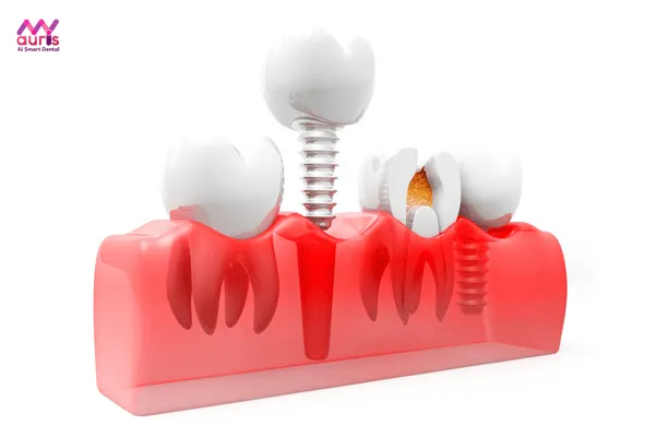 Phương pháp trồng răng implant mất bao lâu?
