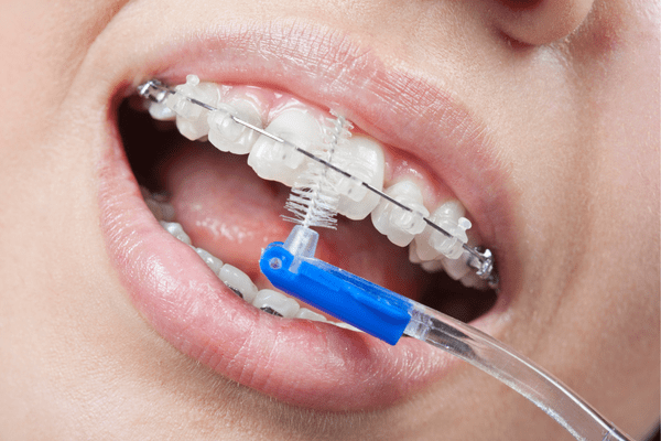 Chăm sóc răng miệng trong quá trình niềng răng hô bằng mắc cài sứ