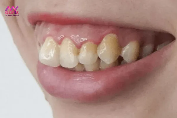 Răng hô là răng như thế nào? niềng răng hô cho người lớn