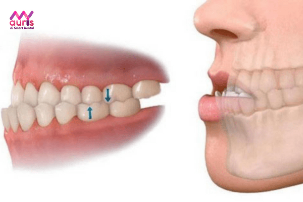 Dấu hiệu nhận biết răng hô hàm dưới - niềng răng hô hàm dưới 