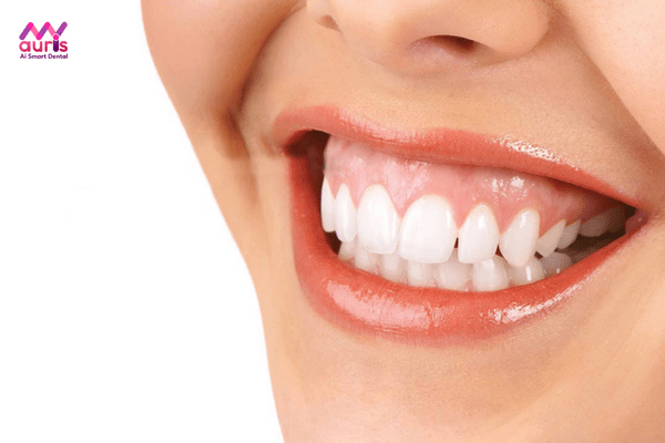 Tình trạng răng hô hở lợi là gì? niềng răng hô hở lợi 