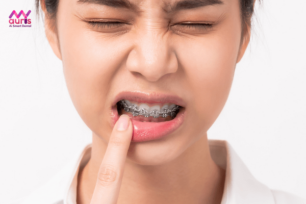 Niềng răng hô tại nhà có thật sự hiệu quả?