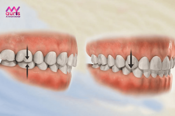 Răng hô là gì? Các biểu hiện của răng hô - niềng răng hô trong suốt