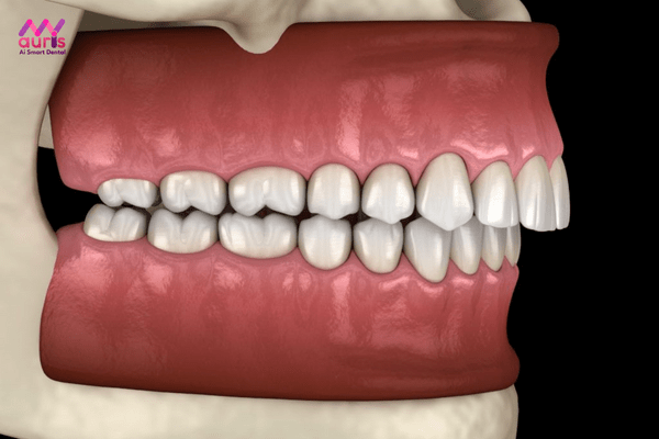 Tìm hiểu về hô xương và mức độ hô như thế nào? niềng răng hô xương 