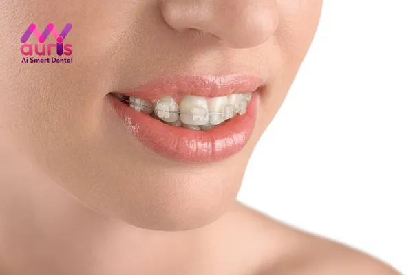 Tìm hiểu niềng răng mắc cài sứ 1 hàm là gì?