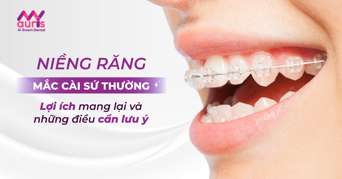 Niềng răng mắc cài sứ thường và những điều cần biết