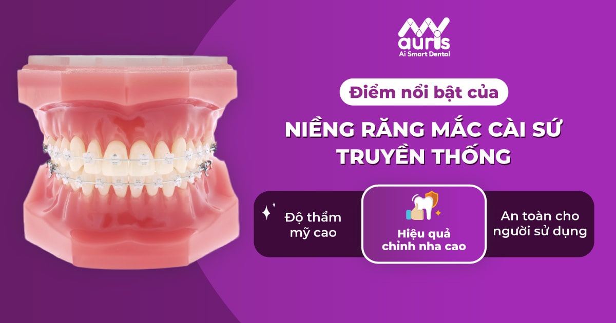 Niềng răng mắc cài sứ truyền thống có điểm gì nổi bật?