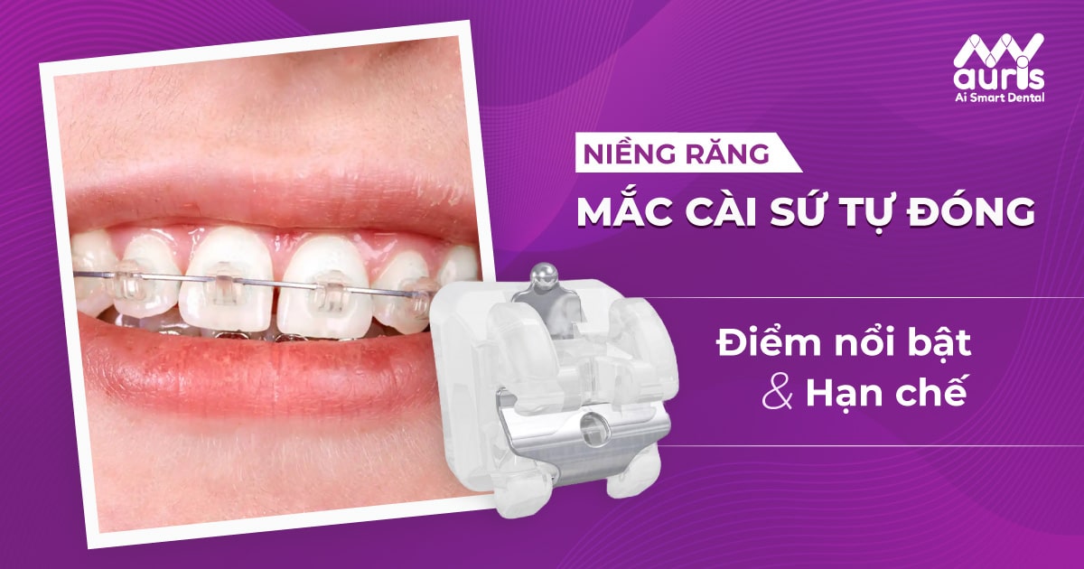 Điểm nổi bật của niềng răng mắc cài sứ tự đóng